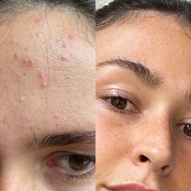 Side-by-side before and after images showing clearer skin.