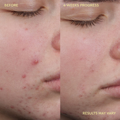 Blemish Acne Clearing Cleanser