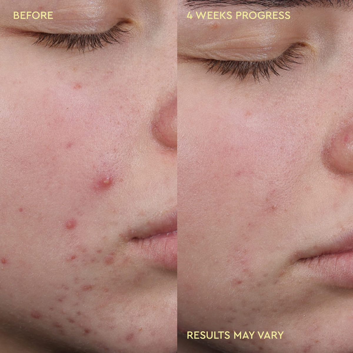 Blemish Acne Clearing Cleanser
