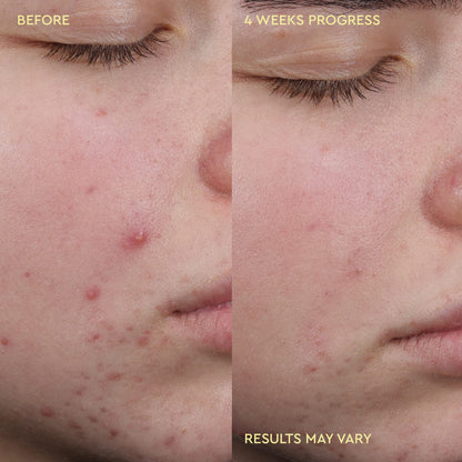 Blemish Acne Clearing Cleanser