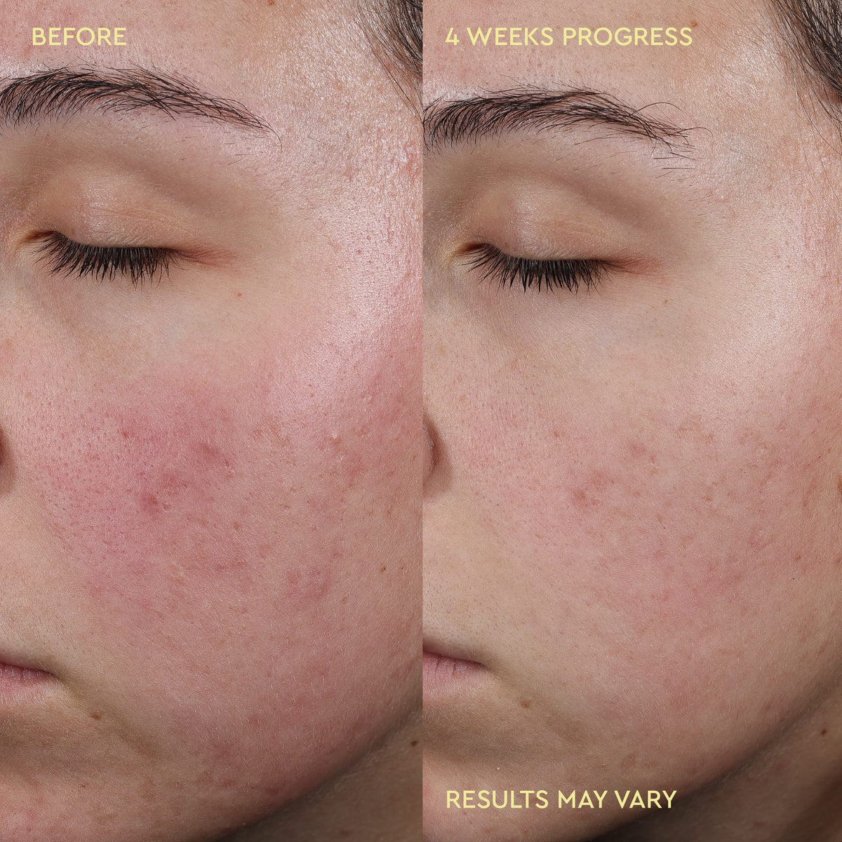 Blemish Acne Control Moisturizer