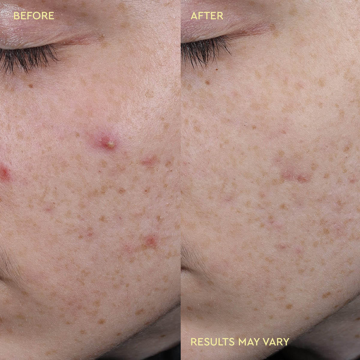 Blemish Acne Treatment Spot Paste