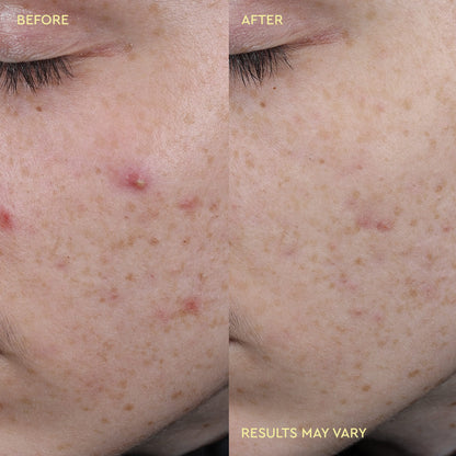 Blemish Acne Treatment Spot Paste